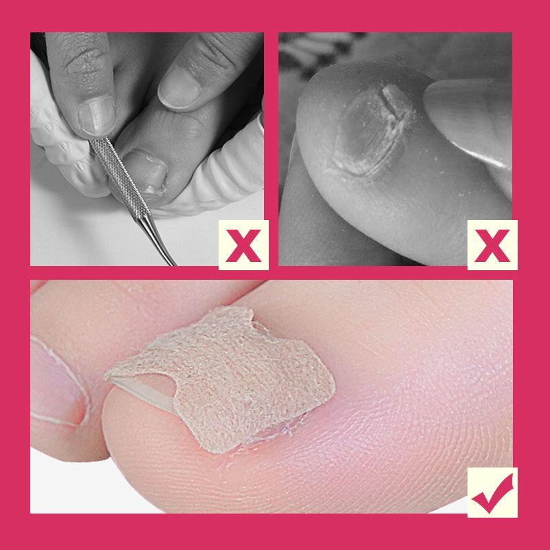 🔥 Glue Free Toenail Patch